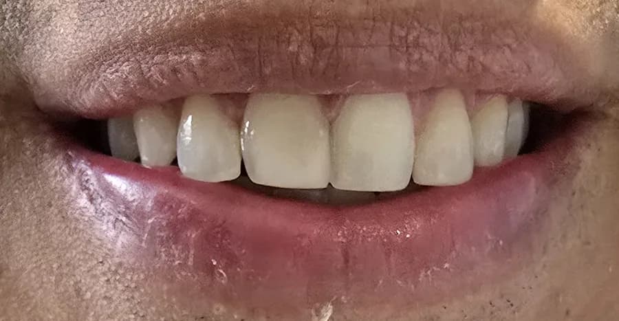 Diseño de Sonrisa Completo — Antes