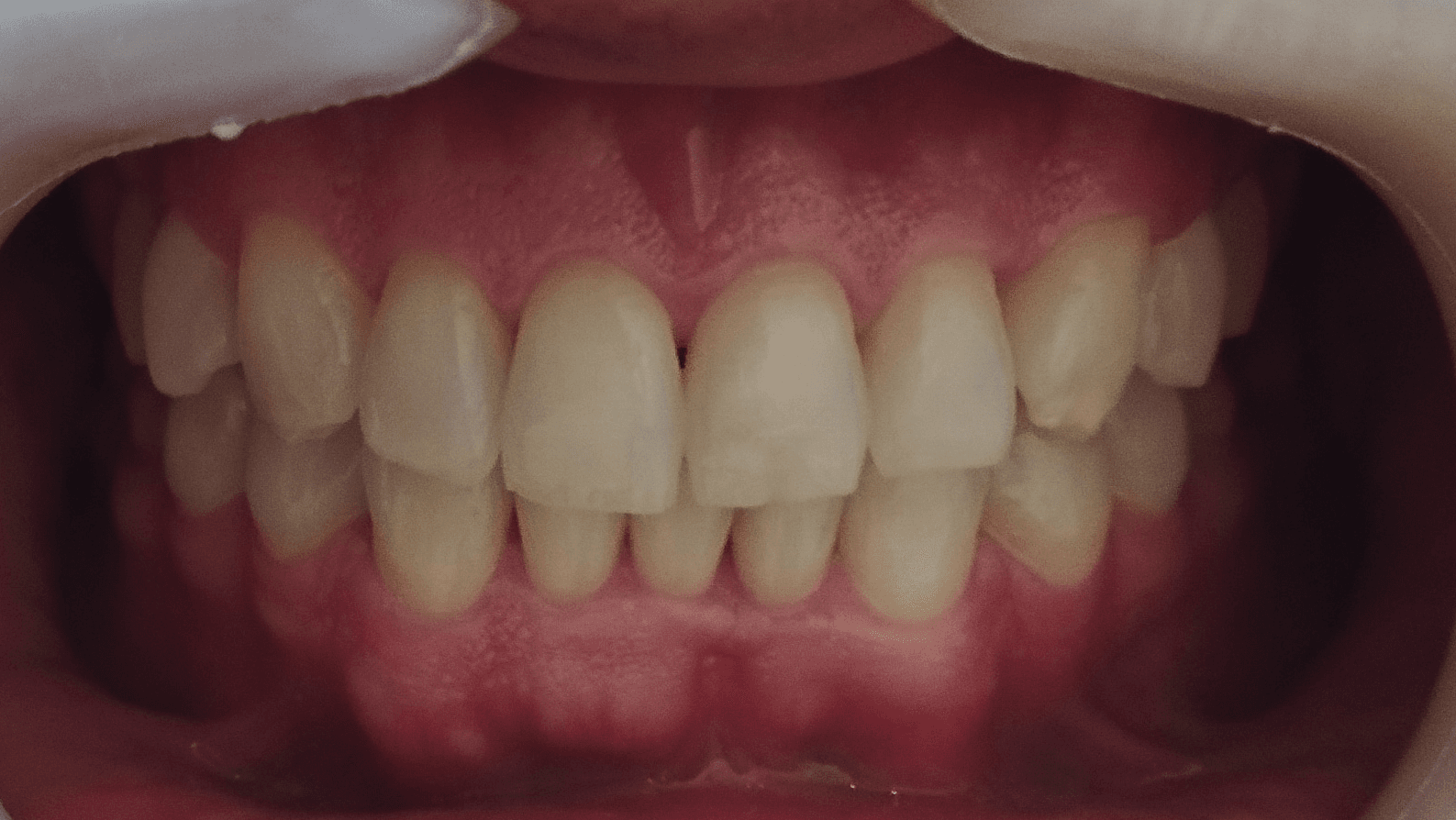 Composite — Antes