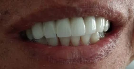 Rehabilitación Oral Total — Después