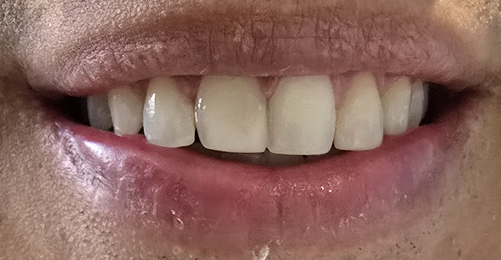 Diseño de Sonrisa Completo — Antes