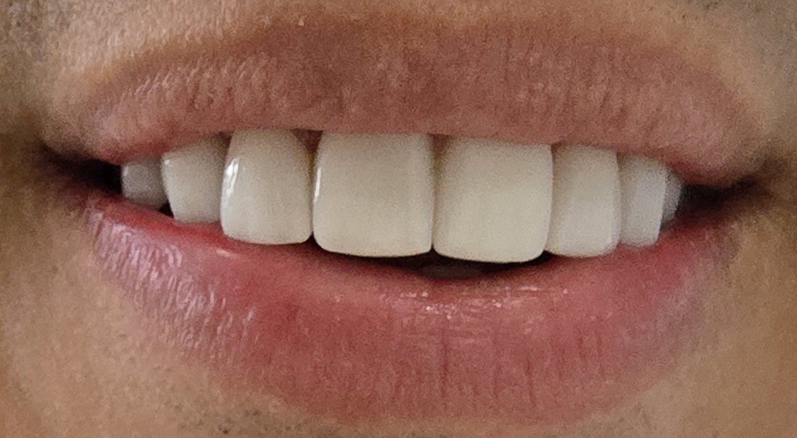 Diseño de Sonrisa Completo — Después