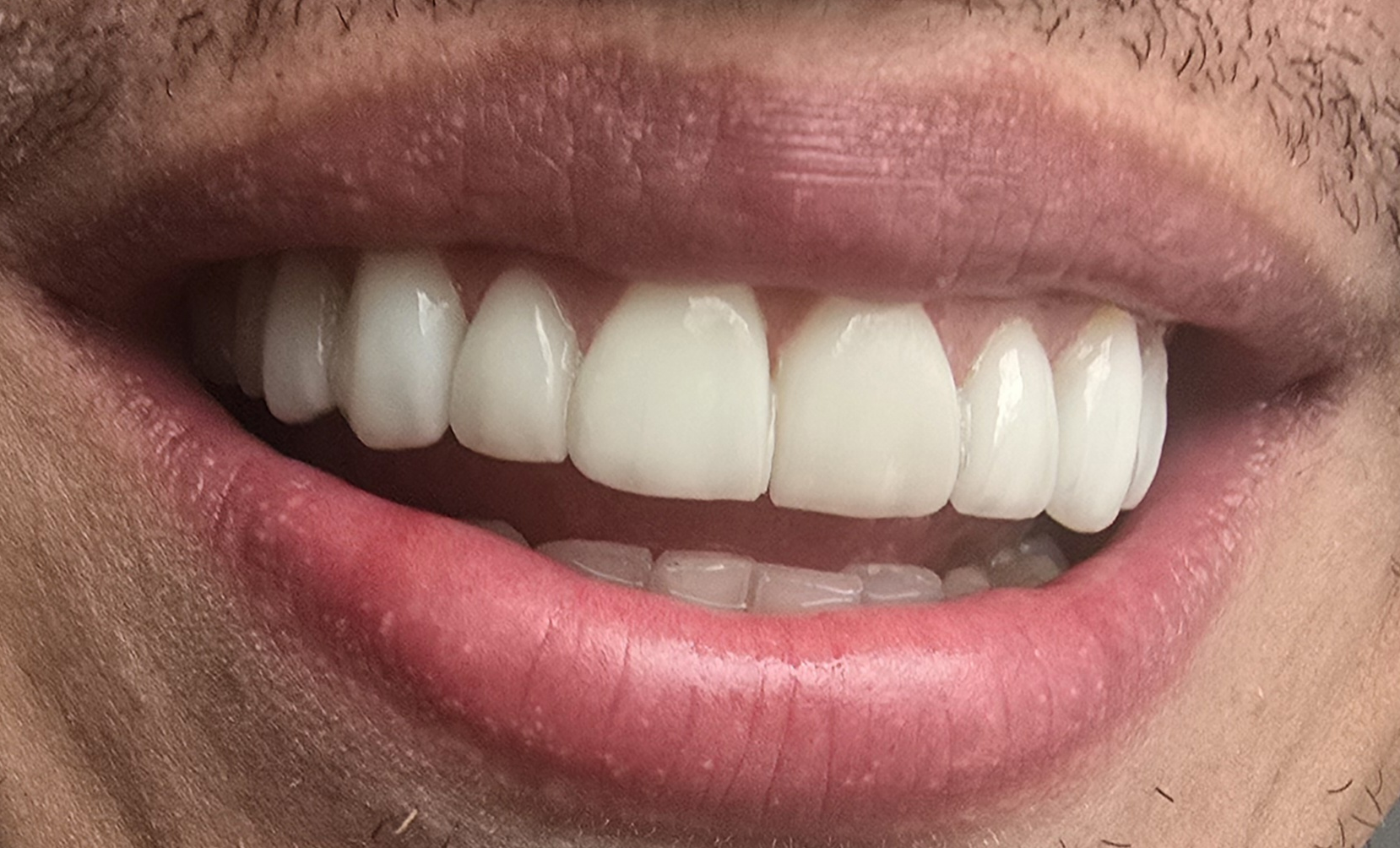 Carillas de Porcelana — Después