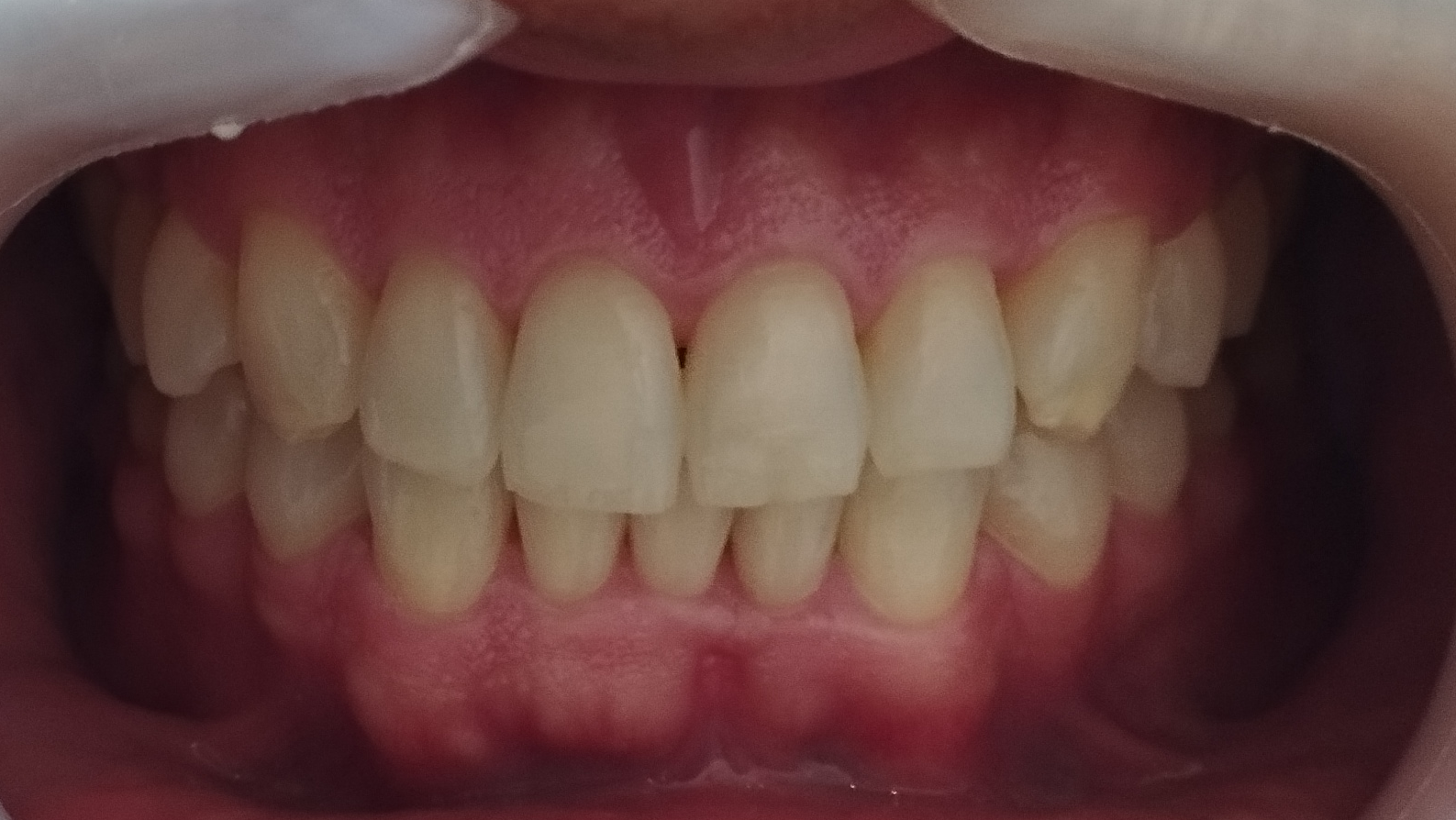 Blanqueamiento + Mini Diseño — Antes