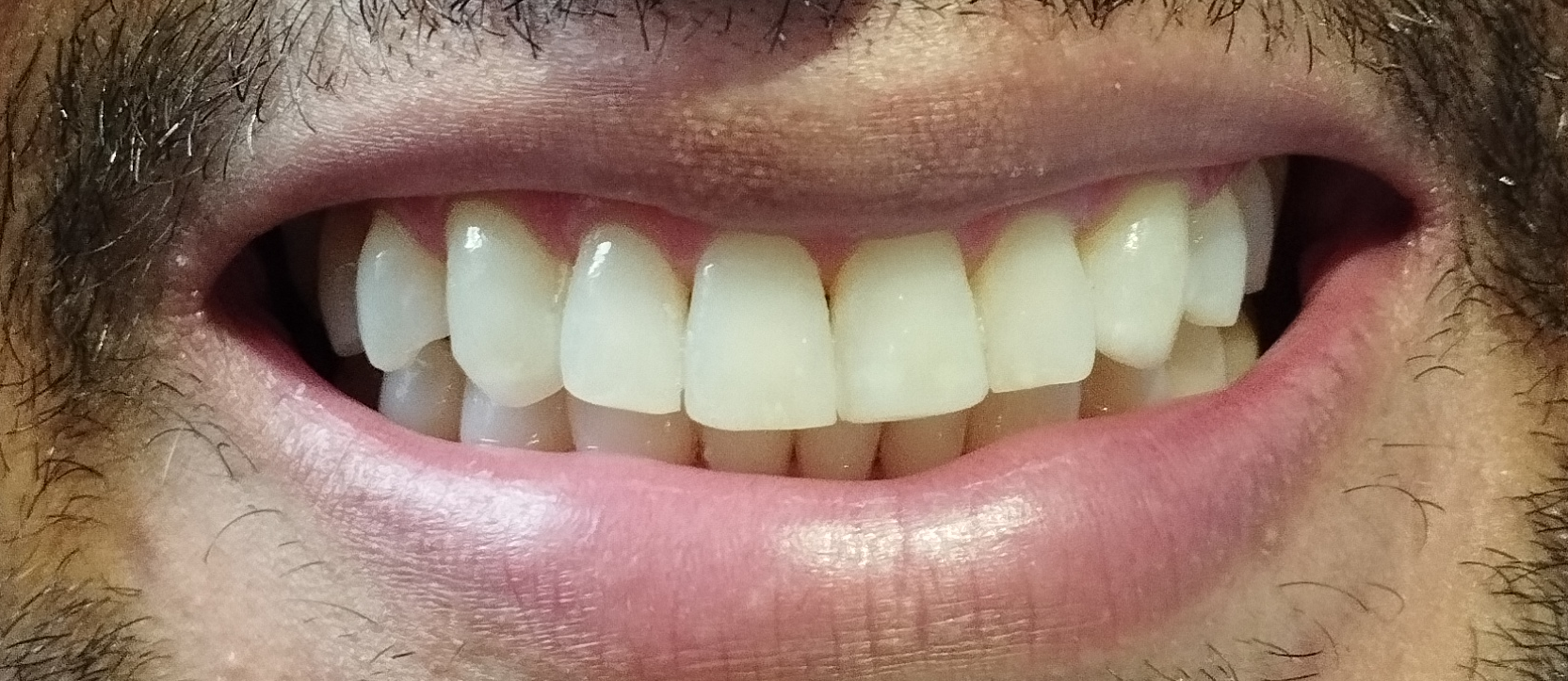 Blanqueamiento + Mini Diseño — Después