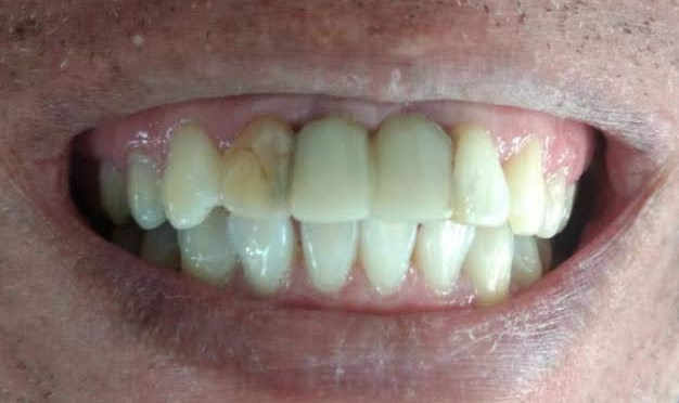 Rehabilitación Oral Total — Antes