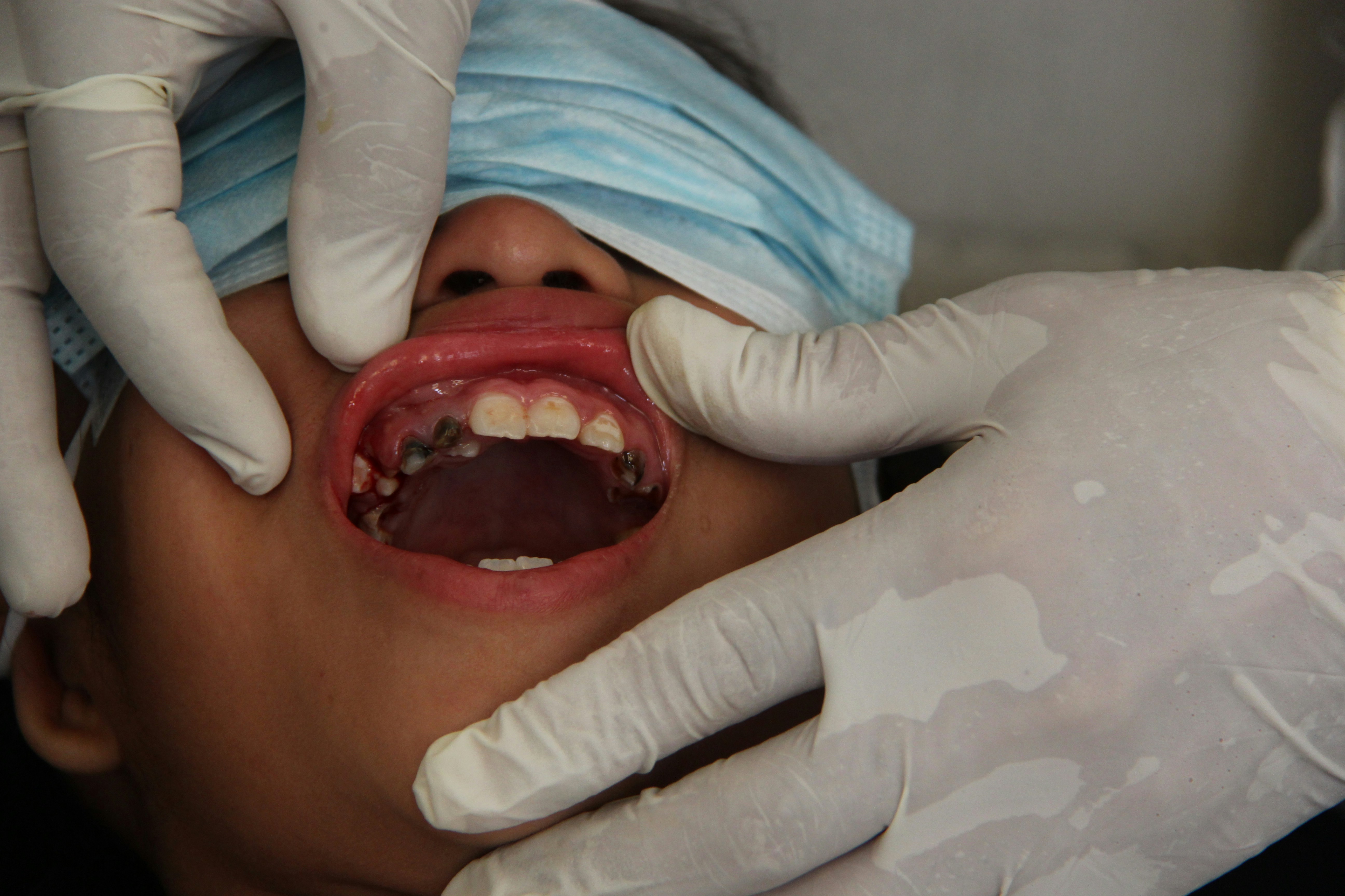 Servicio de endodoncia oral en dentalcare