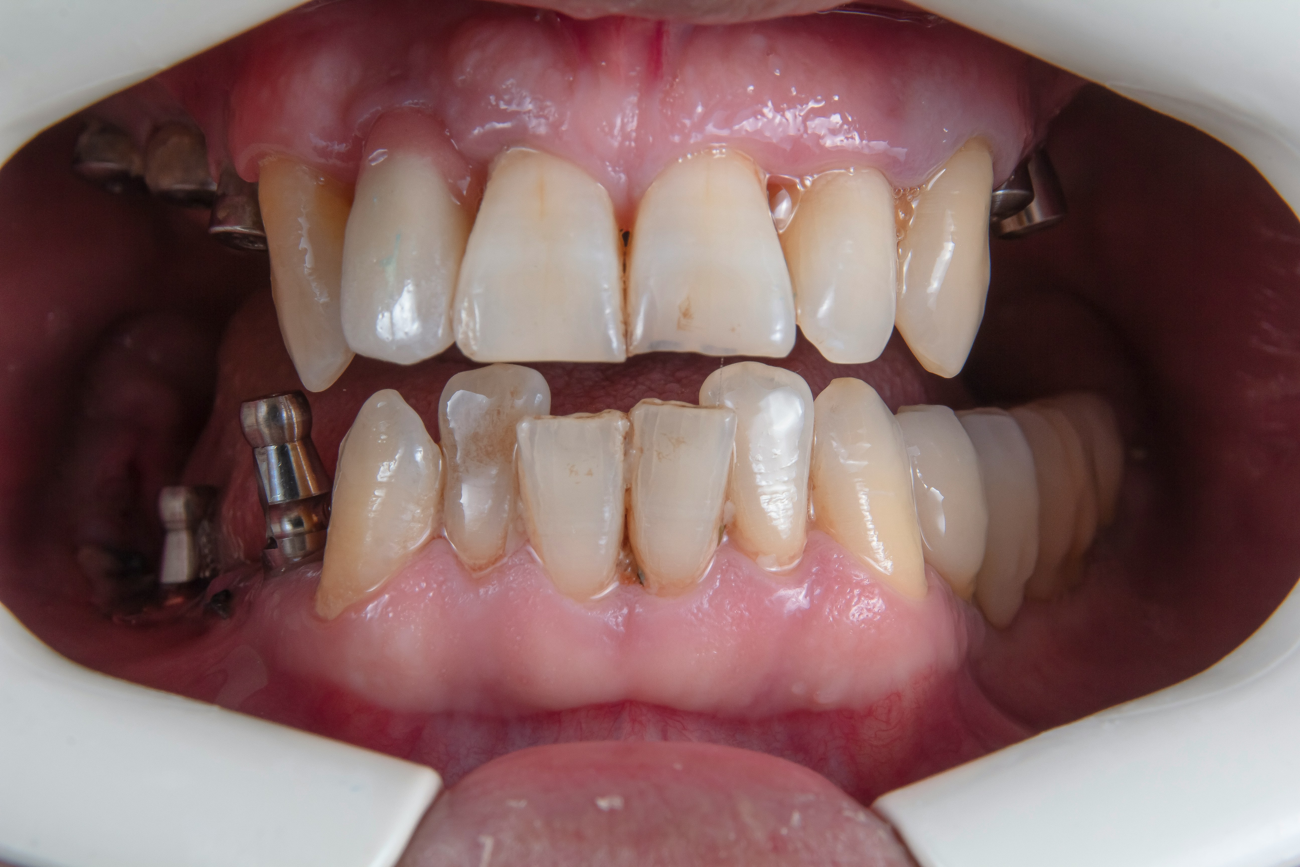 Servicio de rehabilitacion oral en dentalcare
